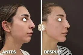 Aumento de mentón en Valencia: evolución estética y evidencia clínica