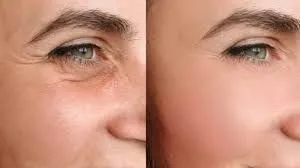 Neuromoduladores: una entrada clave en la cronología de la estética actual